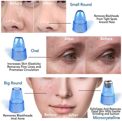 Derma Suction Blackheads Remover LivSmart